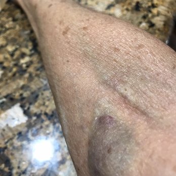 Biomat USA - see the swelling and massive blood pooled where she pulled my arm reaching for her dropped gauze - Blood & Plasma Donation Centers Near Me - Royal Palm Beach, Florida