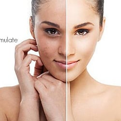 Apollo Beauty Salon - Microdermabrasion
