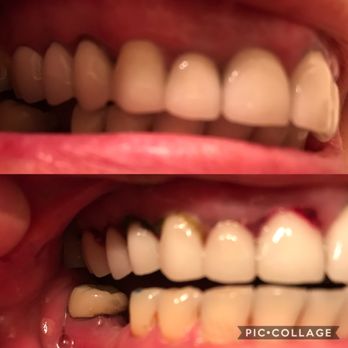 Smile Studio - Bottom picture taken after the LANAP. Top picture taken a few days later. - General Dentistry Near Me - Upland, California Smile Studio - Bottom picture taken after the LANAP. Top picture taken a few days later. - General Dentistry Near Me - Upland, California