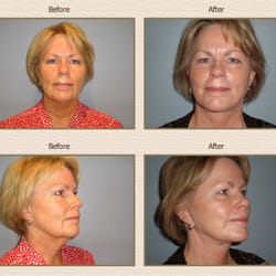 Rocheford Plastic Surgery - Facelift Before and After