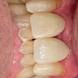 Elite Care Dental - Finished results after dental implants and crown placement