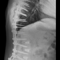 UF Health North - You can see where my construct is turning me into the letter C by pushing me forward way to much.