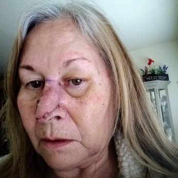 Penn State Dermatology - This was a carve job in my opinion - Dermatologists Near Me - Hershey, Pennsylvania Penn State Dermatology - This was a carve job in my opinion - Dermatologists Near Me - Hershey, Pennsylvania