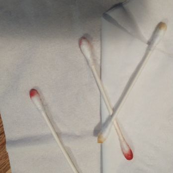 Albany ENT & Allergy Services - Visible yellow wax and red blood. - Allergists Near Me - Albany, New York Albany ENT & Allergy Services - Visible yellow wax and red blood. - Allergists Near Me - Albany, New York