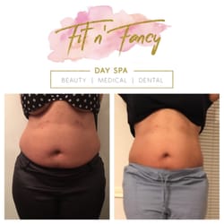 Fit & Fancy Day Spa - Loose 2"+ inches in as little as 20 minutes from a Strawberry Laser Lipo treatment