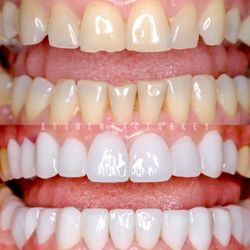 BGZ Dental Turkey