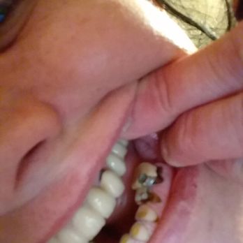 Advanta Dental - 1-year old upper bridge showing separation and how it smashed my lower teeth.  Bridge is falling off!  This is what I got for $13,000. - General Dentistry Near Me - Scranton, Pennsylvania