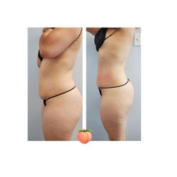 Whitening at Tiffany's - Bedfore and after one session of wood therapy body sculpting treatment