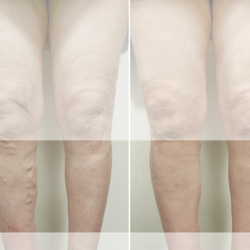 Vena Vein Clinic - Sherman oaks - Varicose veins before and after pictures of VeNA vascular lab & vein clinic patient.