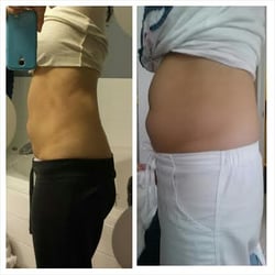 Berman Cosmetic Surgery & Skin Care Center - Before and after smart lipo 1 mo post surgery