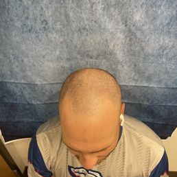 Before first session after hair is trimmed down Before first session after hair is trimmed down