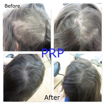 Virginia Surgical Center - anxiety pulling repaired by prp and nutrafol - Hair Loss Centers Near Me - Virginia Beach, Virginia Virginia Surgical Center - anxiety pulling repaired by prp and nutrafol - Hair Loss Centers Near Me - Virginia Beach, Virginia