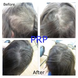 Virginia Surgical Center - Anxiety pulling repaired by prp and nutrafol