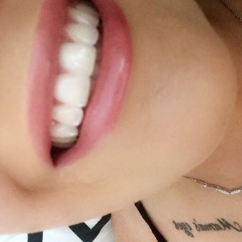 SkinSpirit - Bellevue - Framed smile much better thanks to Amaris and juvederm - Skin Care Near Me - Bellevue, Washington