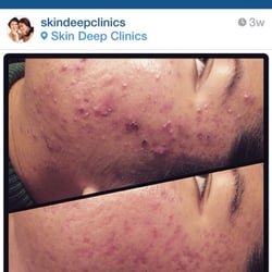 Skin Deep Clinics - This is a patient's results after their first treatment and sticking to their home care regimen! Awesome progress!  We're so proud!