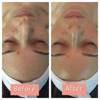 Spa721 - Results: Glowing, hydrated, flawless skin. Less pigmentation and more youthful complexion. - Skin Care Near Me - Ballwin, Missouri Spa721 - Results: Glowing, hydrated, flawless skin. Less pigmentation and more youthful complexion. - Skin Care Near Me - Ballwin, Missouri