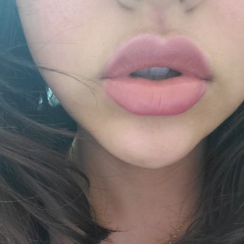 Plush Derma - After 2 syringes Juvederm (with makeup on) - Medical Spas Near Me - Huntington Park, California Plush Derma - After 2 syringes Juvederm (with makeup on) - Medical Spas Near Me - Huntington Park, California