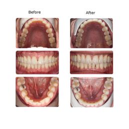 This is the before and after of my invisalign experience. Highly recommend! This is the before and after of my invisalign experience. Highly recommend!