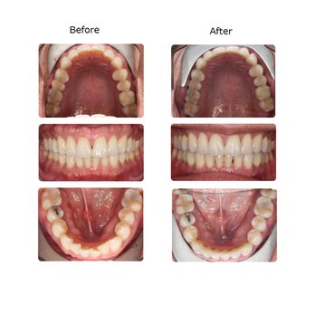 Bella Smile - This is the before and after of my invisalign experience. Highly recommend! - Orthodontists Near Me - San Francisco, California Bella Smile - This is the before and after of my invisalign experience. Highly recommend! - Orthodontists Near Me - San Francisco, California