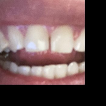Norma Gomez, DDS - after braces taken off-gap. - Orthodontists Near Me - Branford, Connecticut Norma Gomez, DDS - after braces taken off-gap. - Orthodontists Near Me - Branford, Connecticut