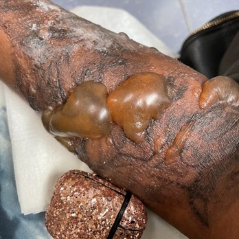 Zapatat - Tattoo Removal Near Me - Arlington, Virginia