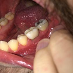 Stevens Family Dental - This is the fakest, ugliest, worst-fitting crown, and they told me for years that it was "fine" and that I would "get used to it"