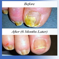 Michael Uro Foot Care - Results after laser treament.