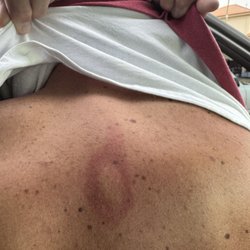 T & L Chinese Massage - this is a burn on my husbands back from the massage rocks