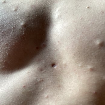 Arya Derm - Pit in chest after steroid injection. Surrounding bumps are steatocystomas under the skin. Now they're much worse and erupt thru the skin. - Dermatologists Near Me - San Francisco, California