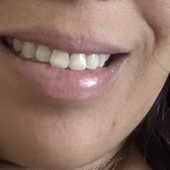 Pure Orthodontics - After braces - Orthodontists Near Me - Las Vegas, Nevada Pure Orthodontics - After braces - Orthodontists Near Me - Las Vegas, Nevada