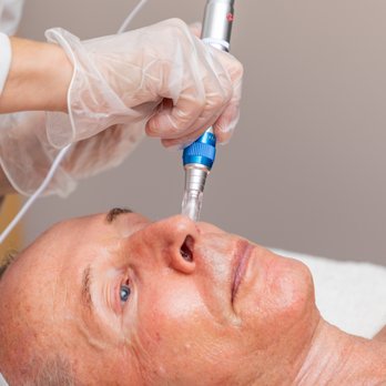 Kai Wellness - Microneedling Facial - Traditional Chinese Medicine Near Me - Santa Fe, New Mexico