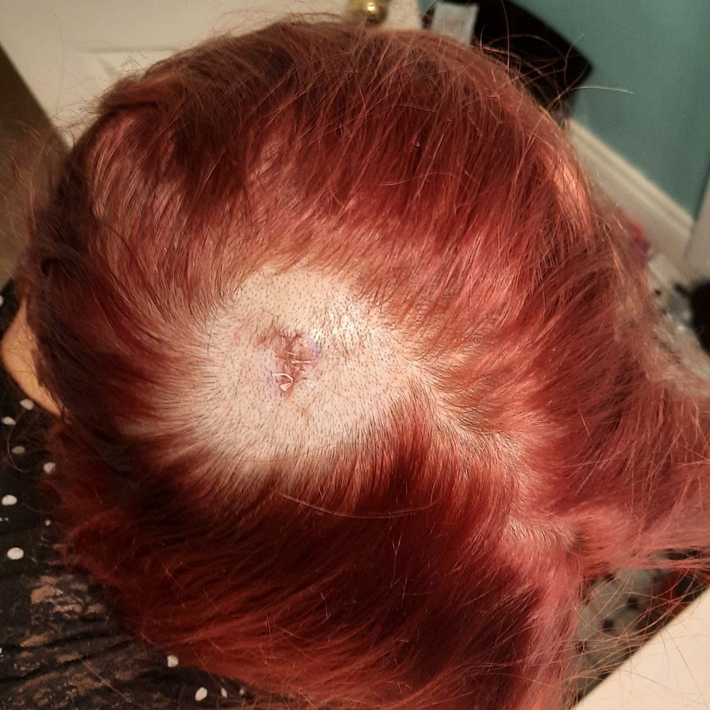 Massive bald spot shaved into my head for a small excision. Total hatchet job and no concern for aesthetics. Massive bald spot shaved into my head for a small excision. Total hatchet job and no concern for aesthetics.