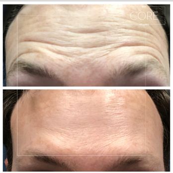 Core Wellness & Longevity - Botox can help help decrease the appearance of fine lines and wrinkles. The bottom photo is two weeks after treatment. - Medical Spas Near Me - Nashville, Tennessee Core Wellness & Longevity - Botox can help help decrease the appearance of fine lines and wrinkles. The bottom photo is two weeks after treatment. - Medical Spas Near Me - Nashville, Tennessee