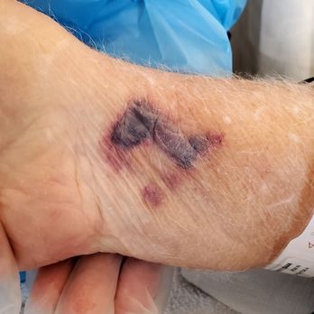 Kindred Hospital Riverside - Trying to draw blood. It hurt him everytime - Hospitals Near Me - Perris, California