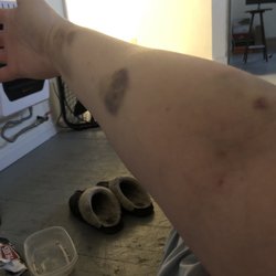 This is just from the blood team trying to poke me