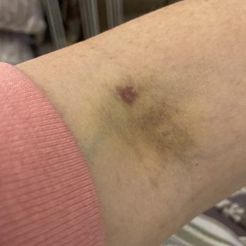 Quest Diagnostics - Bruising (3 days post appointment) - Laboratory Testing Near Me - Wethersfield, Connecticut Quest Diagnostics - Bruising (3 days post appointment) - Laboratory Testing Near Me - Wethersfield, Connecticut