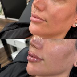 Enve California Aesthetics - Lip Filler by RN Taylor
