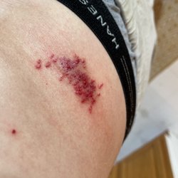 Center for SmartLipo & Plastic Surgery - As you can see this new session looks AWFUL. I'm concerned that my skin may be permanently scarred. JAGGED as h*** !!!!!!!!!!