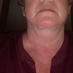 Lyle M Back, MD - Cobra neck