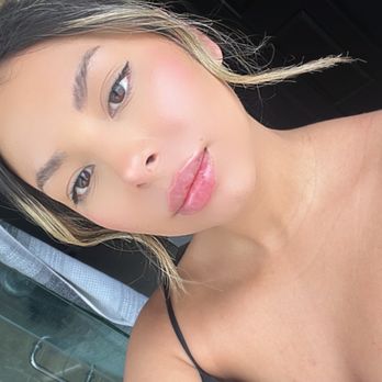 Essensa Clinic - Right after lip filler, swollen but perfectly shaped - IV Hydration Near Me - Las Vegas, Nevada Essensa Clinic - Right after lip filler, swollen but perfectly shaped - IV Hydration Near Me - Las Vegas, Nevada