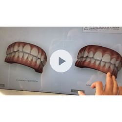 Shiney Smiles Orthodontics - Rendition of what my teeth look like right now and what they would look like after Invisalign