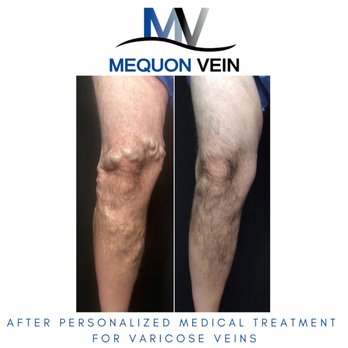 Mequon Vein - Germantown - Vascular Medicine Near Me - Germantown, Wisconsin Mequon Vein - Germantown - Vascular Medicine Near Me - Germantown, Wisconsin