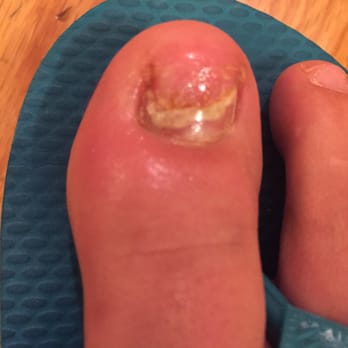 Jeeyune Nails & Spa - A worsening infection from nail fugus. What a price to pay for a pedicure! - Nail Salons Near Me - Montclair, New Jersey Jeeyune Nails & Spa - A worsening infection from nail fugus. What a price to pay for a pedicure! - Nail Salons Near Me - Montclair, New Jersey