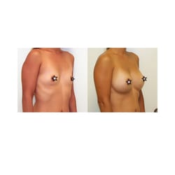 Michael Pasquale, DO - Best Breast Implant Surgeon Dr Michael Pasquale