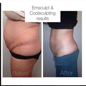 Solganics - 16 week progress naturally - Alternative Medicine Near Me - Dunwoody , Georgia Solganics - 16 week progress naturally - Alternative Medicine Near Me - Dunwoody , Georgia