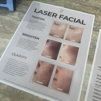 SEV Laser - Laser facial - Laser Hair Removal Near Me - Yorba Linda, California SEV Laser - Laser facial - Laser Hair Removal Near Me - Yorba Linda, California