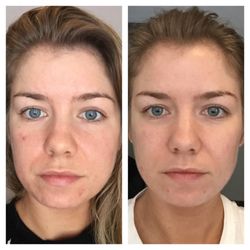 DS Skin Care & Waxing Studio - Success story from RA Acne Treatments