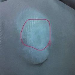 Joseph Knedgen, DPM FACFAS DABFAS - Red circle area of original corn