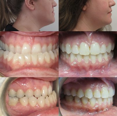 Before/Afters - Accepting New Patients! Call today at (626) 285-5800 to schedule a free consultation! Find us at the
corner of Las Tunas Dr and Primrose Ave in Temple City. We offer several treatment options to fit
your needs including traditional braces, cosmetic braces, and clear aligners including Invisalign Before/Afters - Accepting New Patients! Call today at (626) 285-5800 to schedule a free consultation! Find us at the
corner of Las Tunas Dr and Primrose Ave in Temple City. We offer several treatment options to fit
your needs including traditional braces, cosmetic braces, and clear aligners including Invisalign