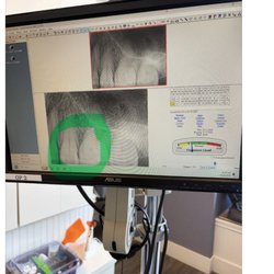 Brian Zwahlen, DDS - Tooth left exposed